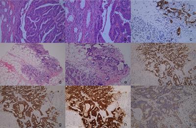 Breast mass as the first sign of metastasis from rectal carcinoma: a case report and review of the literature